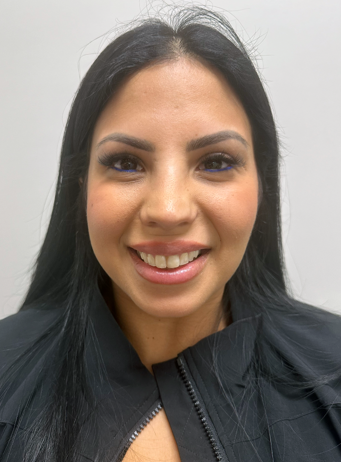 Botox patient results