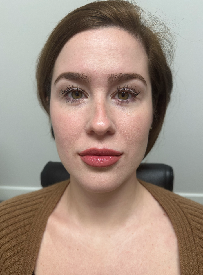 Botox patient results