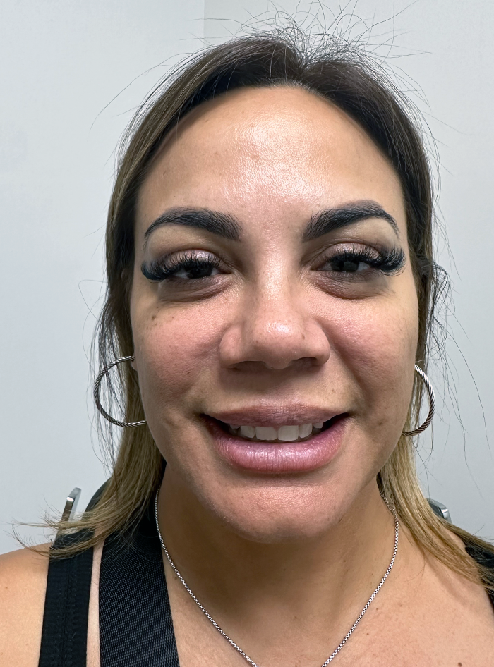 Botox patient results