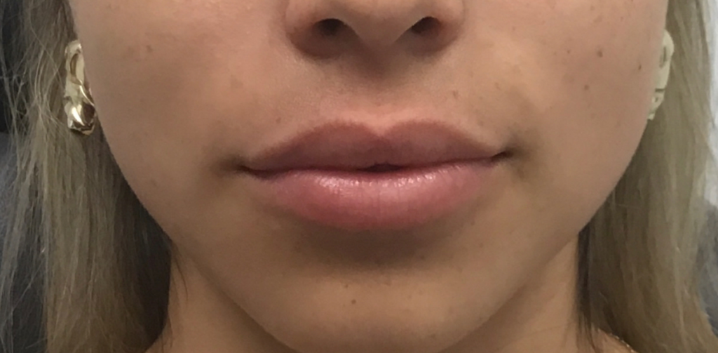 Before