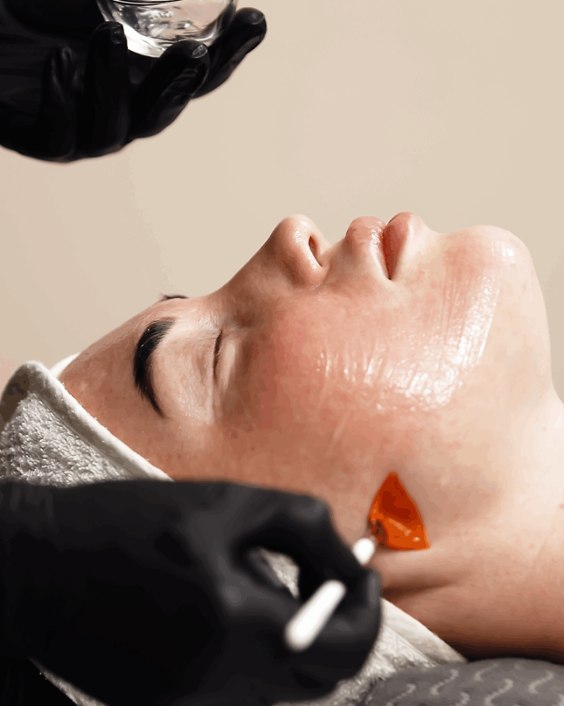 Graft Clinics. Chemical peel. Medical procedure.