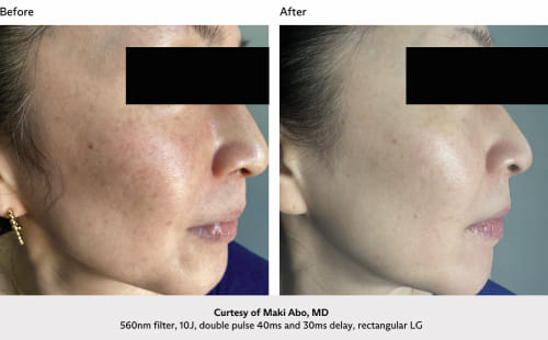 stellar-before-after-12
