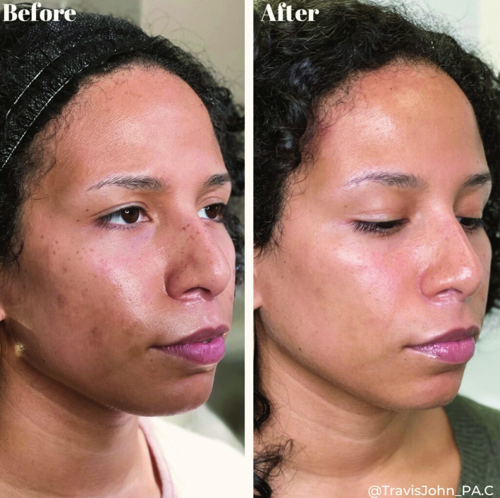Before and after comparison showing improved skin tone, texture, and clarity after Stellar M22 treatment