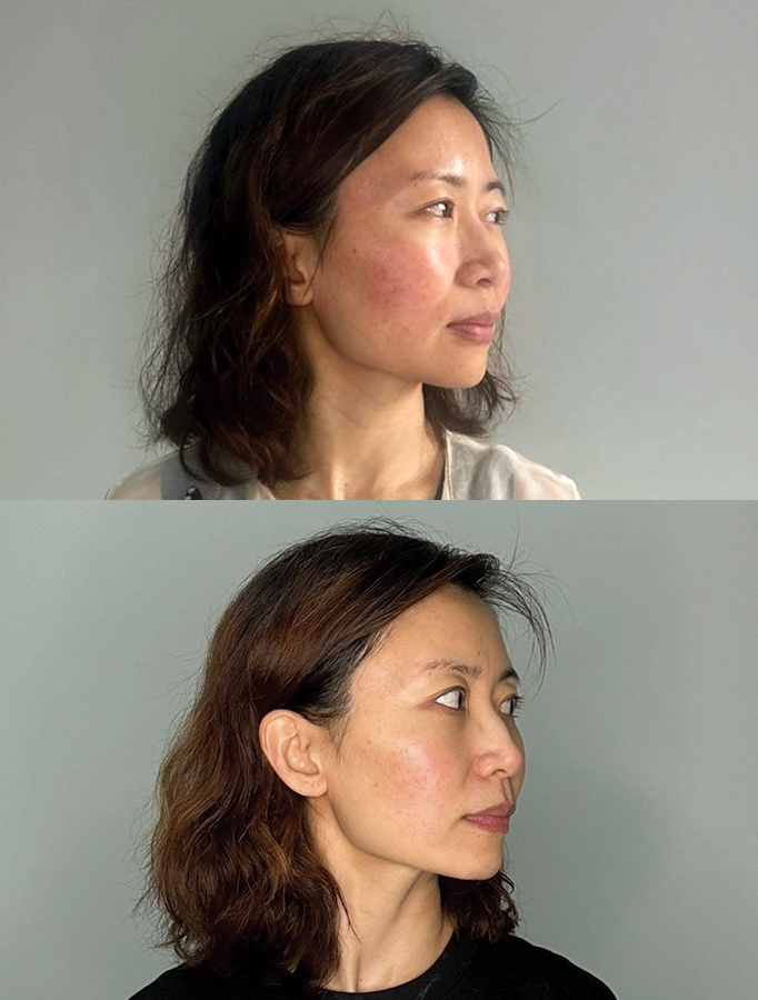 Before and after views showing skin redness and improvement during Stellar M22 recovery and aftercare process