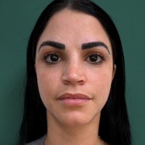 After - Patient 4