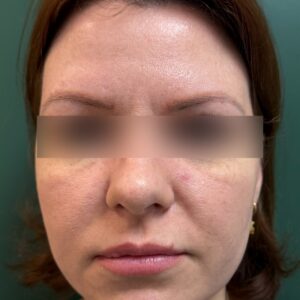 Before - Patient 3