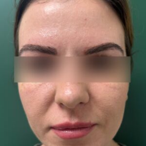 After - Patient 3