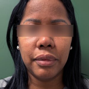 Before - Patient 1