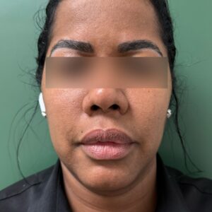 After - Patient 1