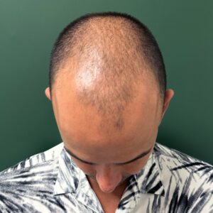 Before - Patient 1