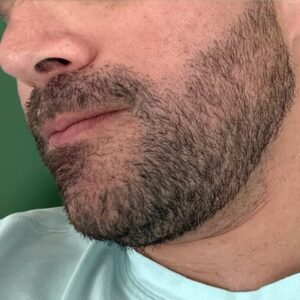After - Patient 1
