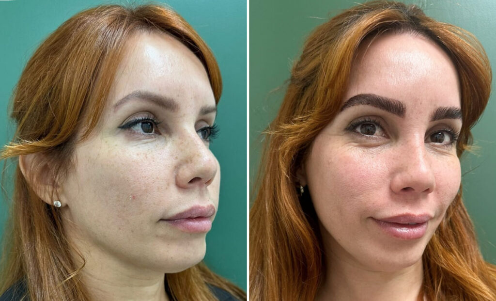 Before-and-after comparison showing fuller, more defined eyebrows when evaluating transplant versus microblading options.