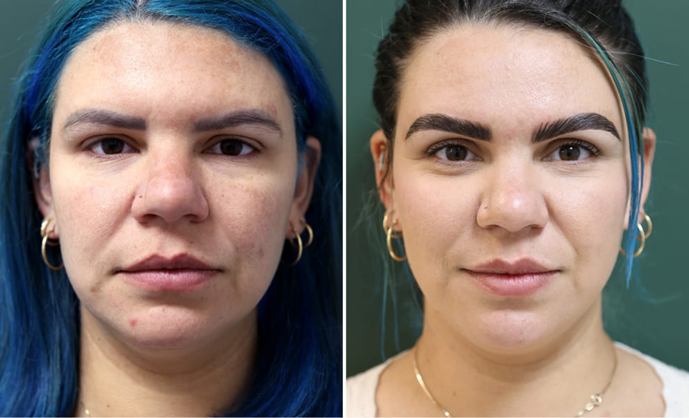 Before-and-after eyebrow transplant comparison showing fuller brows in a patient with naturally sparse eyebrow hair.