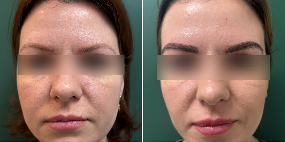 Before-and-after eyebrow transplant comparison showing fuller, more defined brows with improved shape and density.