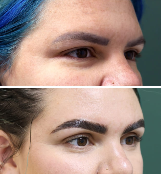 Before-and-after eyebrow transplant comparison showing fuller, more defined brows after recovery and new hair growth.