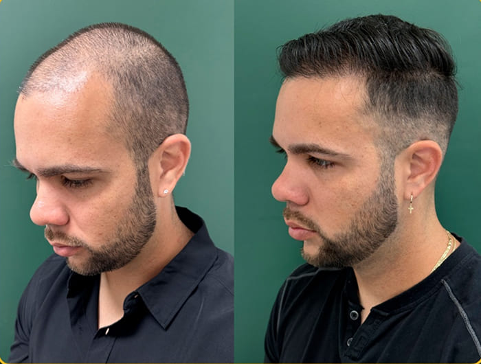 Before-and-after hair transplant comparison illustrating factors that can influence healing and recovery time.