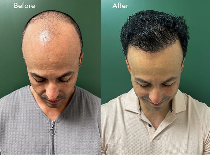 Before-and-after hair transplant comparison showing improved scalp coverage and fuller hair growth during recovery.
