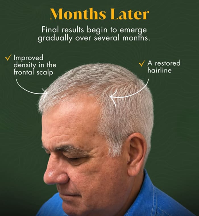 Man months after a hair transplant showing improved frontal density and a restored hairline as final results emerge.