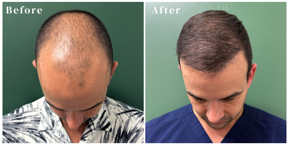  Graft Hair Restoration and Aesthetics hair loss  treatment patient
