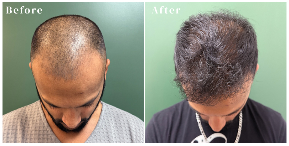  Graft Hair Restoration and Aesthetics hair loss  treatment patient - top view